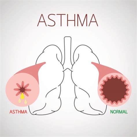Best Asthma Illustrations Royalty Free Vector Graphics And Clip Art Istock