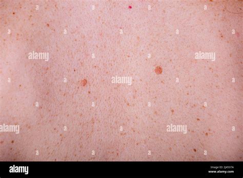 Moles On The Skin Stock Photo Alamy