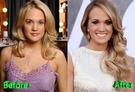 Carrie Underwood Plastic Surgery Looking Better Than Ever