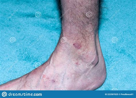 Atopic Eczema Stock Image Image Of Africa Eczema African 222587025