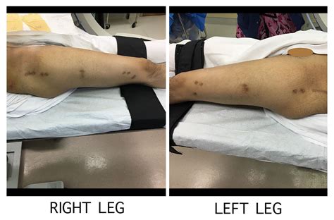 Height Increase Surgery Bone Lengthening In Hollywood California