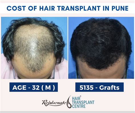Hair Transplant Cost In Pune Best Hair Transplant Clinic In Pune