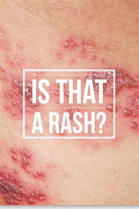 Is That A Rash Maybe Maybe Not Wound Care Specialists Are Often