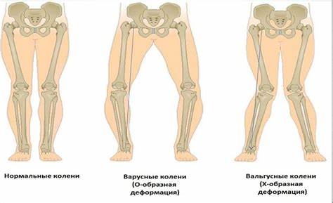 Коленный сустав артроз диета