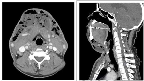 Cureus Rare Angina A Case Report Of Ludwigs Angina