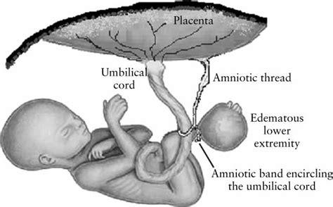 What Is Amniotic Band Syndrome Pregnant Health Tips