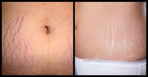 Do You Know The Difference Between Purple Stretch Marks And White