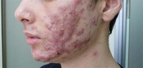 Figure 1 From Resolution Of Nodulocystic Acne With Oral Dapsone