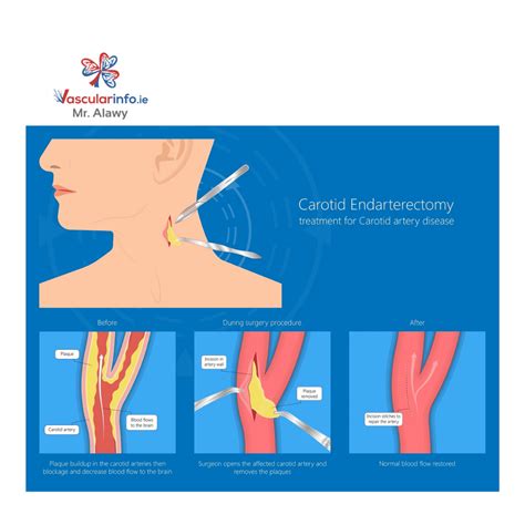 Carotid Endarterectomy Vascular Info