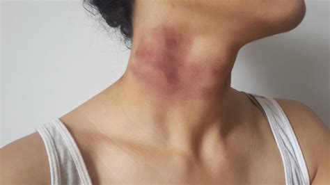 How To Make A Bruise Without Makeup Saubhaya Makeup
