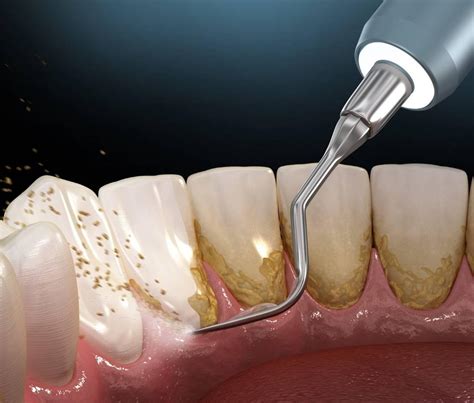 Dental Plaque What You Need To Know