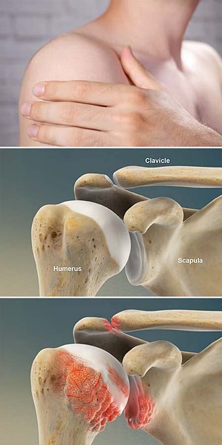Rheumatoid Arthritis Ra Of The Shoulder Central Coast Orthopedic