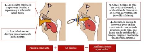 Relación Entre Los Hábitos De Succión No Nutritivos Y La Maloclusión
