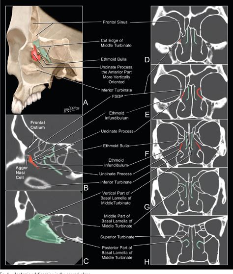 Figure 9 From The Frontal Sinus Drainage Pathway And Related Structures