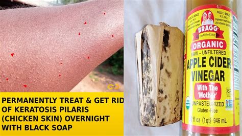 How To Naturally Treat To Get Rid Of Keratosis Pilarischicken Skin