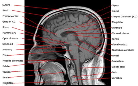 Annotated Sagittal T1 Midline Mri Scan Of Reighs Brain Flickr