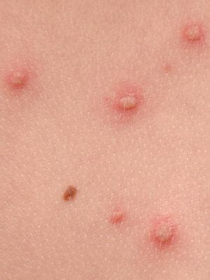 Causes Of Itchy Red Bumps On The Skin Skin Care Resea Vrogue Co