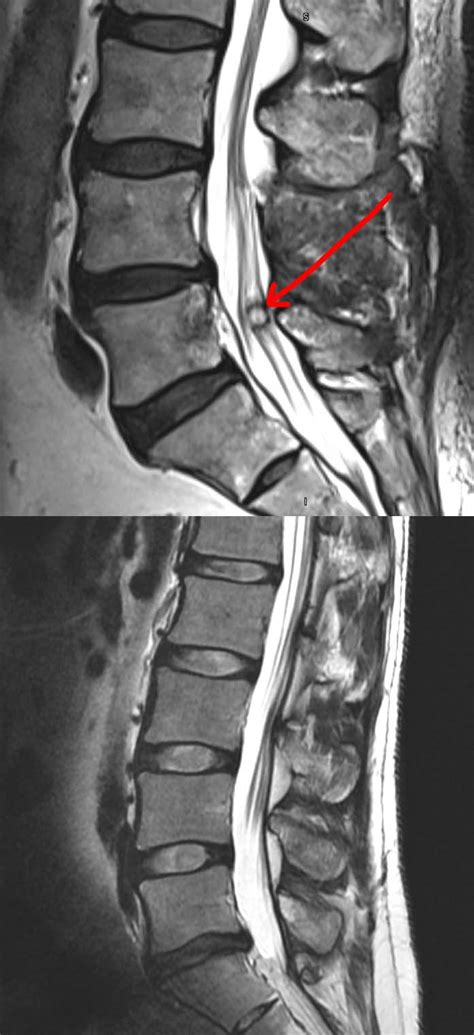 Synovial Cyst Of The Spine Symptoms Diagnosis Treatment