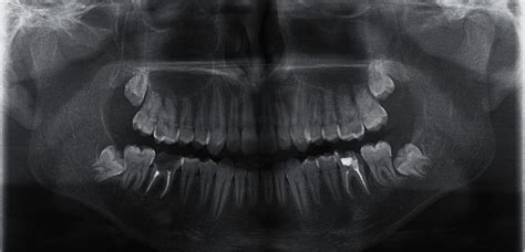 Autotransplantation Of Two Immature Third Molars With The Use Of L Prf