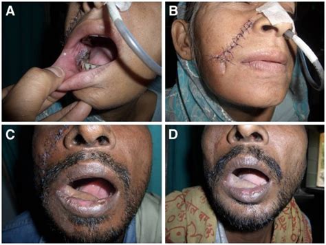 Nasolabial Flap Reconstruction In Oral Cancer World Journal Of
