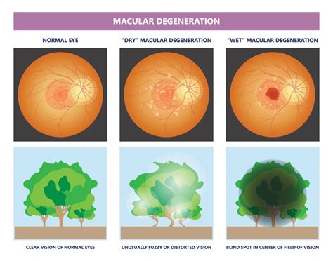 Age Related Macular Degeneration Dry And Wet AMD Specialist