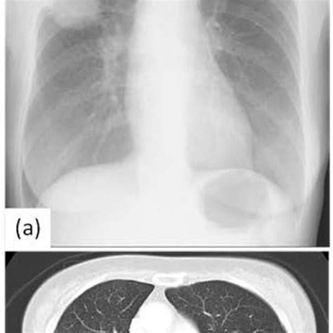 Chest X Ray And Computed Tomographyct Shows A Huge Tumor In The Right