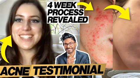 Acne Before And After Without Skin Care Routine Doctor Explains Youtube