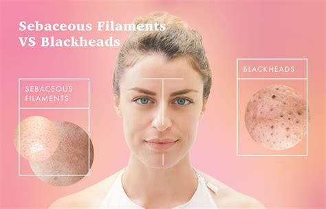 Sebaceous Filaments Vs Blackheads And How To Get Rid Of Them