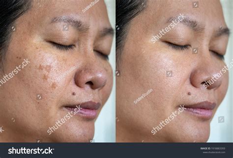 Image Before After Spot Melasma Pigmentation Stock Photo