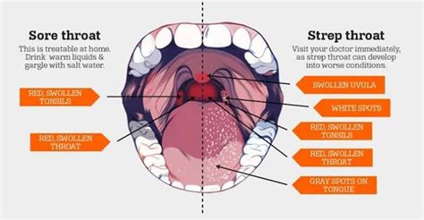 Strep Throat White Spots On Tonsils