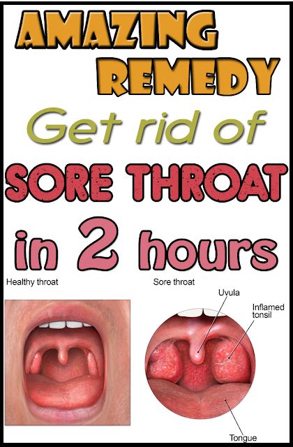 Wonderful Remedy To Get Rid Of Sore Throat In 2 Hours Strep Throat