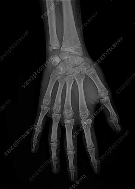 Healthy Hand X Ray Stock Image F0393311 Science Photo Library