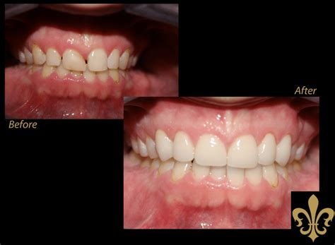 In order to solve this problem, he always turned to the dentist. See some of our before and after images of REAL patients!