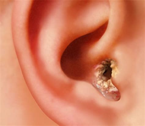 Dry Skin In Ears Causes Flaky Earlobe Crusty No Wax Scaly Patch