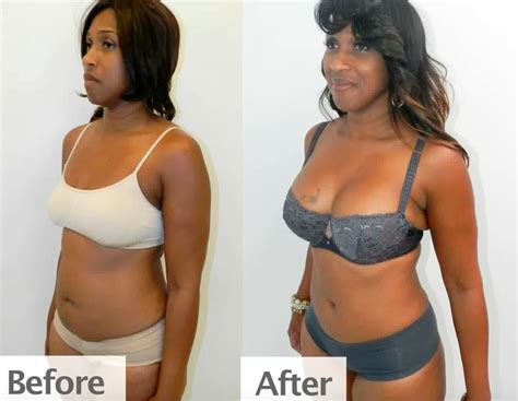 Large Breast Lift Before And After