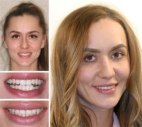 Clear Braces In Brooklyn Orthodontics Envy Smile Dental Spa