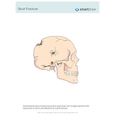 Skull Fracture