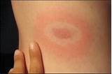 Photos of Lyme Disease Rash Itch Treatment