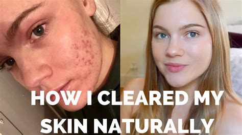 My Acne Story Hormonal Clearing My Skin Naturally Youtube