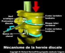 Hernie Discale Causes Sympt Mes Traitements Sympt Mes Causes Et