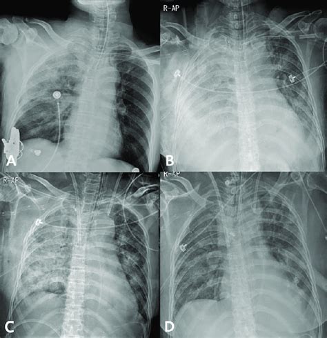 Chest X Rays Showing Clinical Progression A Initial X Ray B