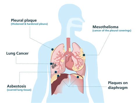 Typically it is caused by the volume of disease on the chest and putting pressure on the esophagus, making the circumference. What is Mesothelioma? - Infinite JLB