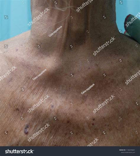Dilated Superficial Veins Secondary Obstructed Superior Stock Photo