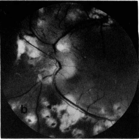 B Scan Ultrasound In Eyes With Vitreous Haemorrhage A Focal