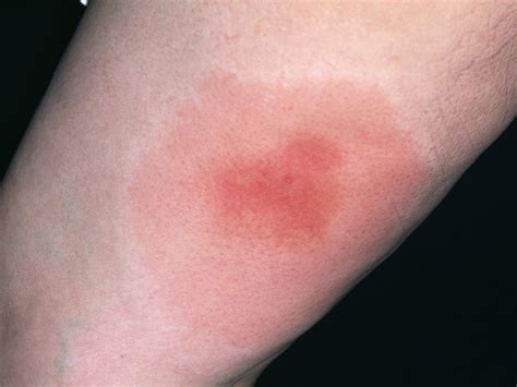 Childhood Rashes Skin Conditions And Infections Photos Babycenter