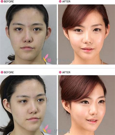 List 101 Pictures Korean Girl Plastic Surgery Before And After Pictures Excellent 102023