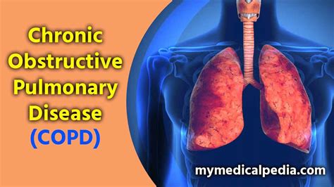 Chronic Obstructive Pulmonary Disease Copd Causes And Symptoms