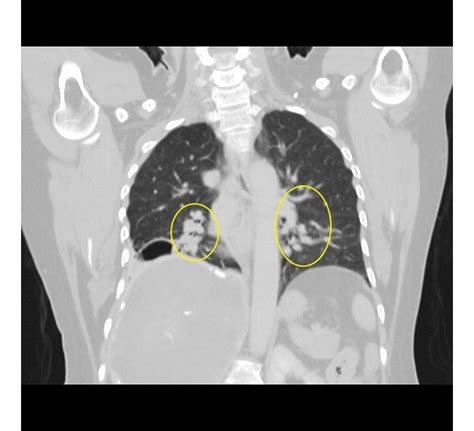 Echinococcosis Ct Wikidoc