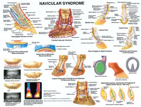 Navicular Syndrome Chart