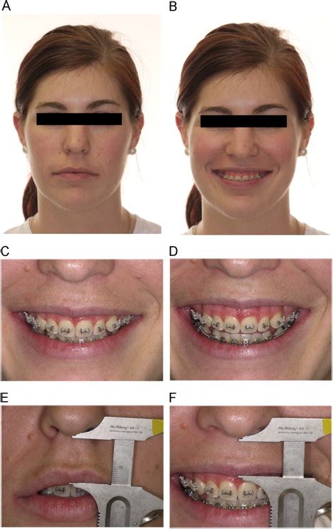 Periodontal Treatment Of Excessive Gingival Display Seminars In